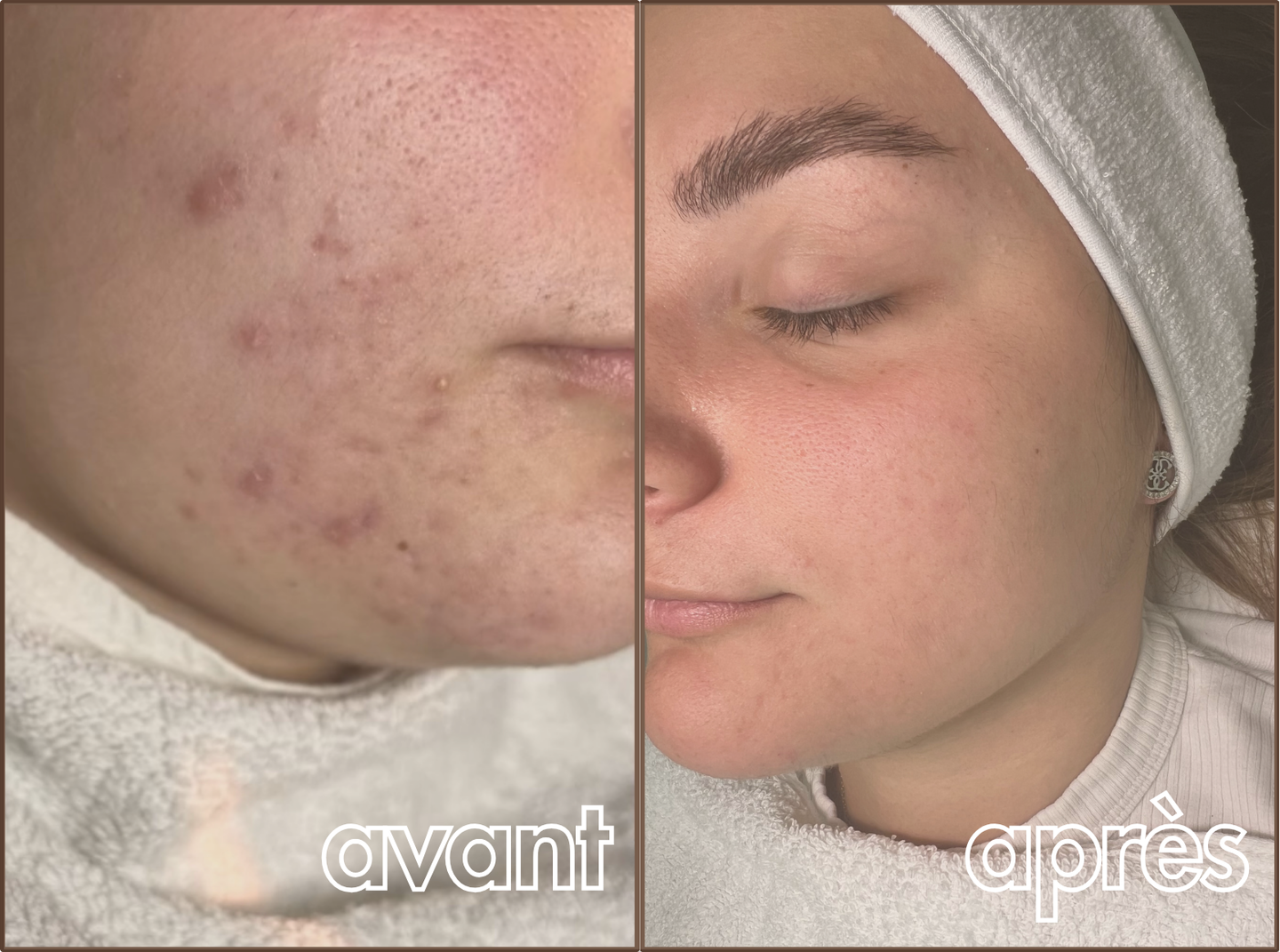 Résultat avant / après