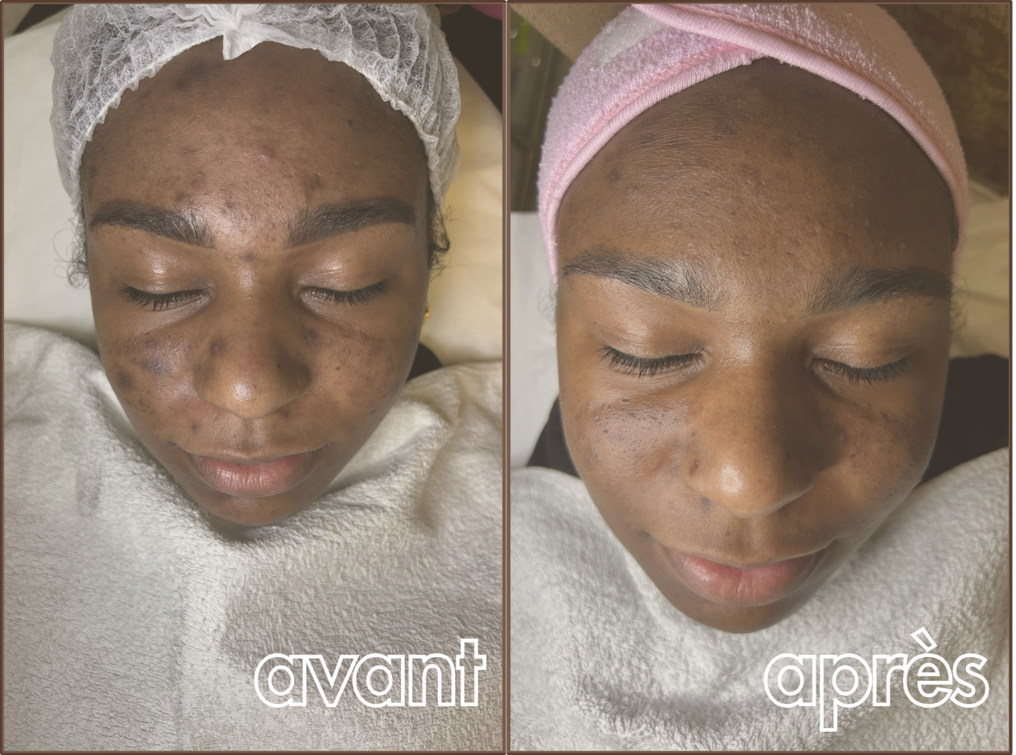 Résultat avant / après