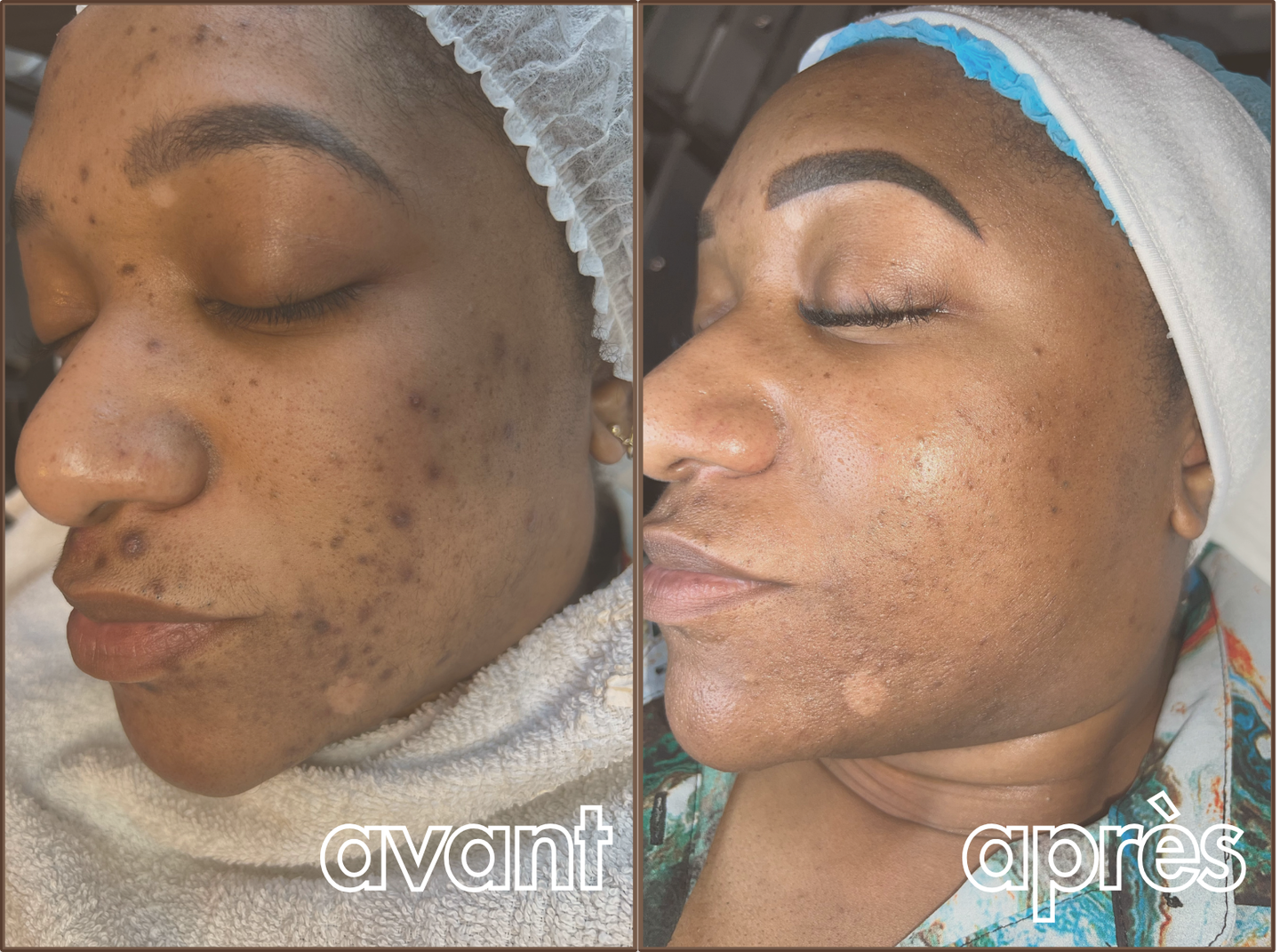 Résultat avant / après