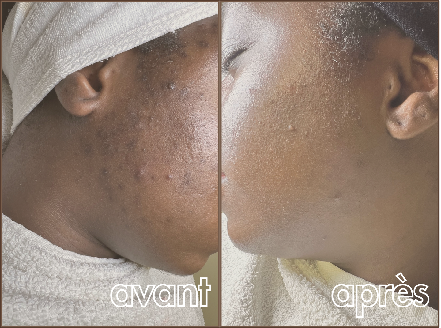 Résultat avant / après