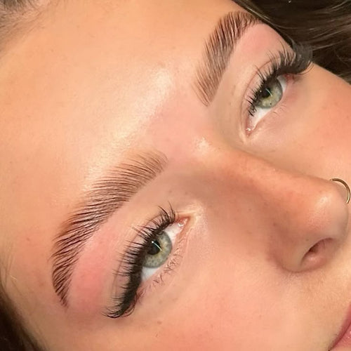 Brow lift
