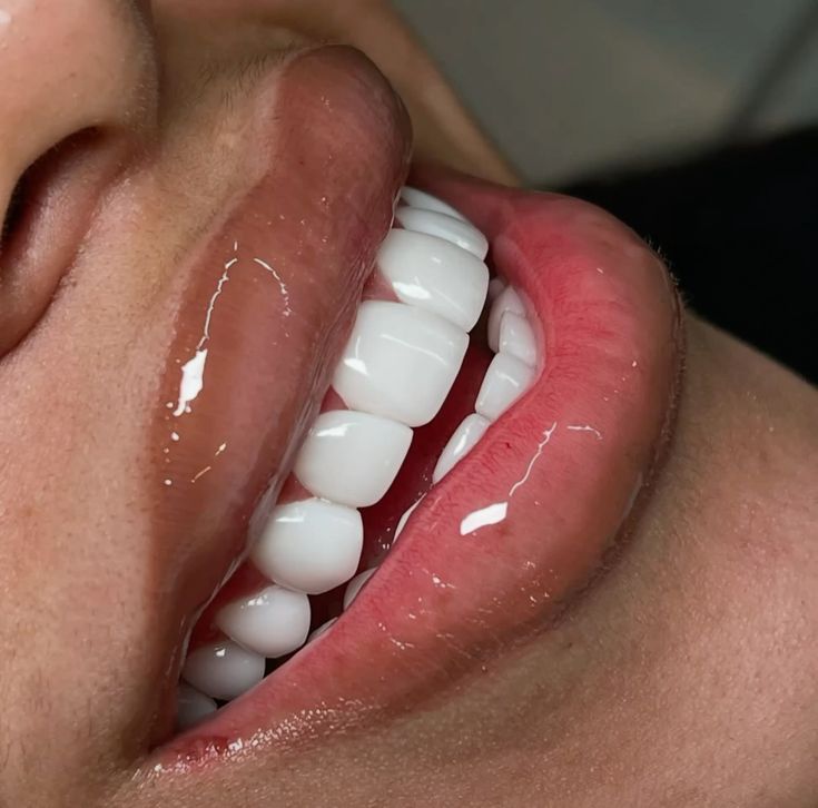 BLANCHIMENT DENTAIRE